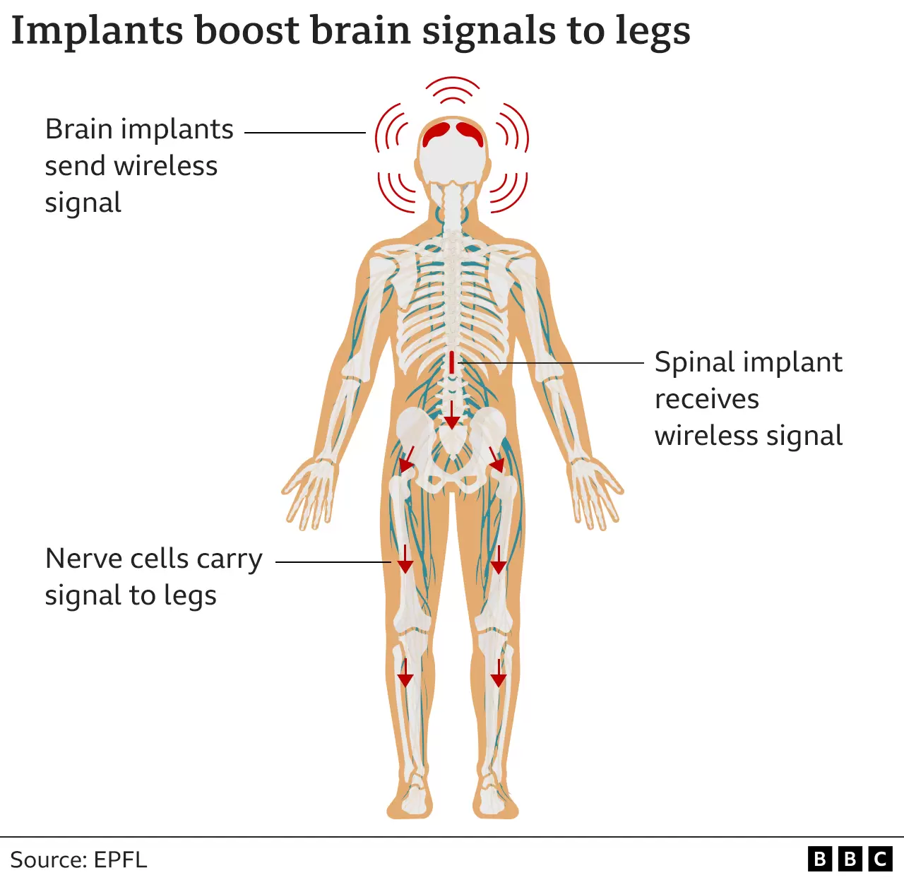 AI acts as a thought decoder and enables brain's signals to bypass damaged parts of the spinal cord to move legs.